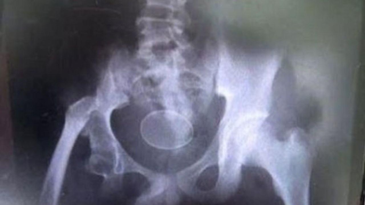 Doktorları bile şaşkına çevirdi... Tavuk gibi yumurtluyor