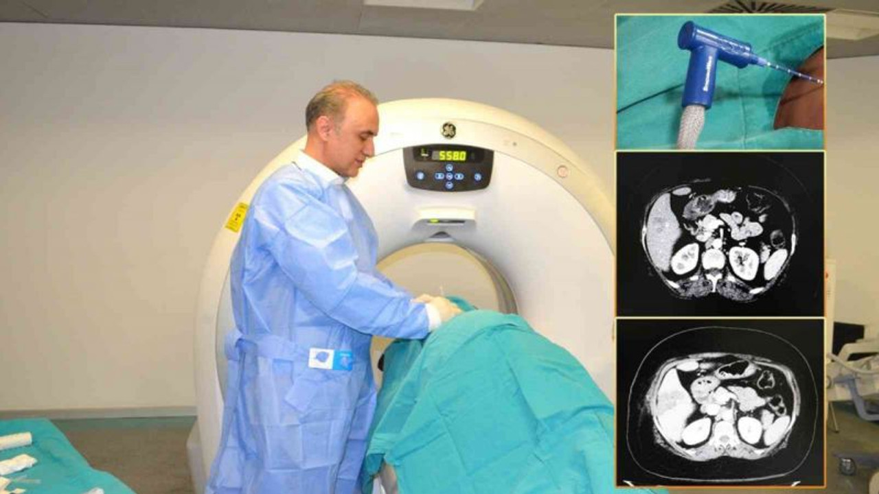 Karaciğer kanseri tedavisinde ‘Mikrodalga Ablasyon’ yöntemi