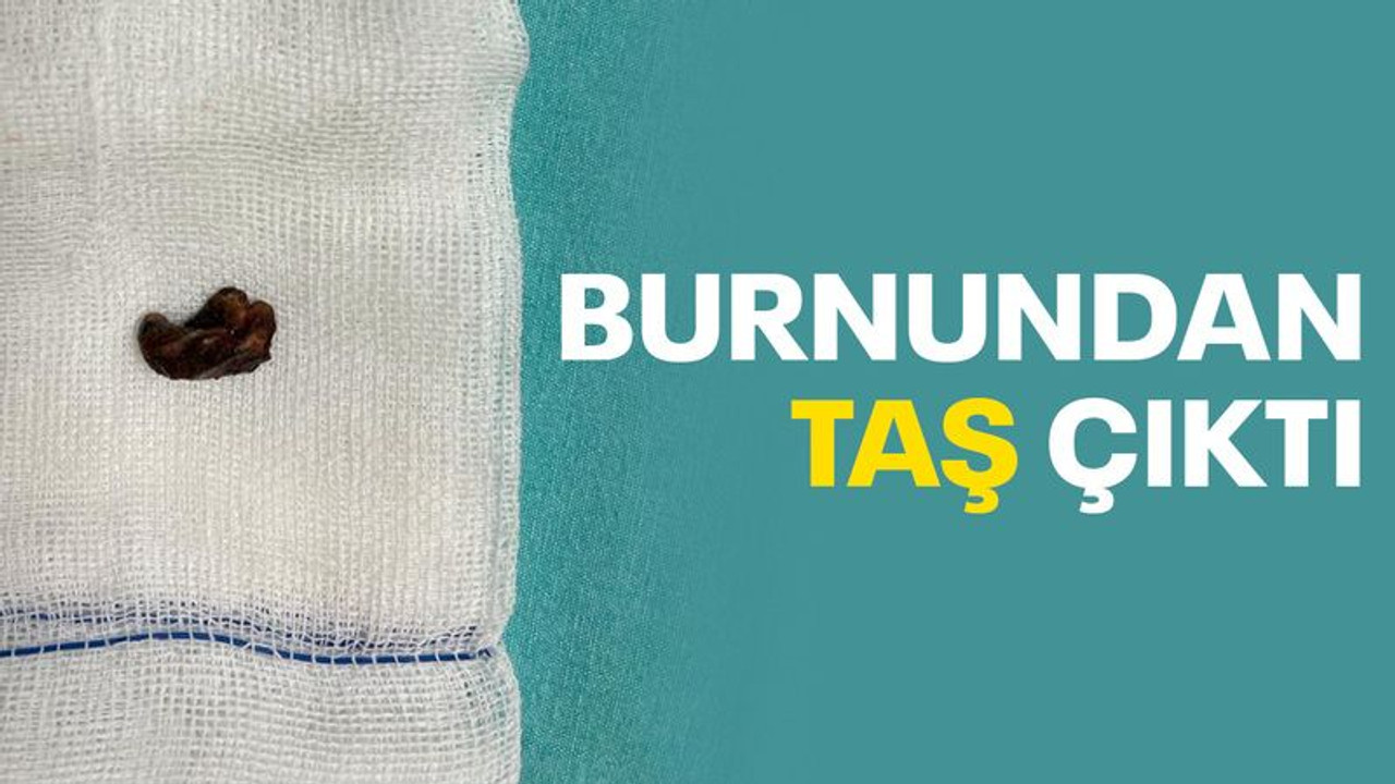 Burnundan taş çıktı