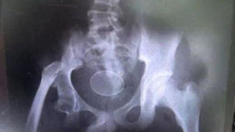 Doktorları bile şaşkına çevirdi... Tavuk gibi yumurtluyor