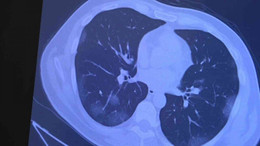 Profesör ilk defa açıkladı: Aşı olanlarda ’omicron’ akciğere inmiyor