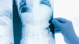 Uzmanlar uyardı: “Akciğer kanseri yüzde 85 sigara kaynaklı”