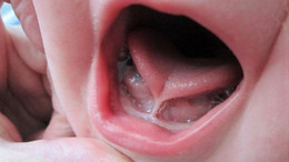 “Dil bağı bebeklerde ciddi gelişim sorunlarına yol açabiliyor”