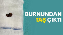 Burnundan taş çıktı