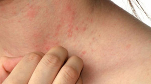 Cilt hastalıklarının kökeni psikolojik olabilir