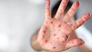 Maymun çiçeği vakasının ülkemizde görülmemesi, rahatlamaya yol açmamalı