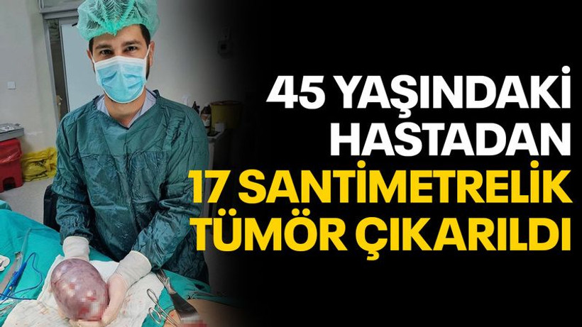 45 yaşındaki hastadan 17 santimetrelik tümör çıkarıldı