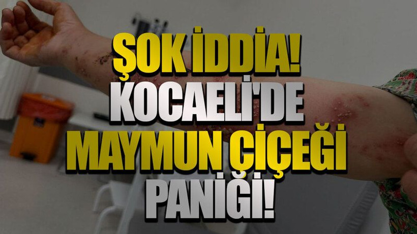 Şok iddia! Kocaeli'de maymun çiçeği paniği!