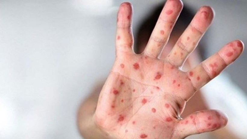 IFRC: Maymun çiçeği salgınının ölçeği sınırlarımızı zorluyor