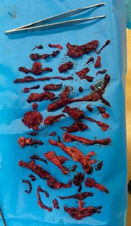 Koronavirüs geçirenlerin akciğerlerinden çıkanlar şoke etti