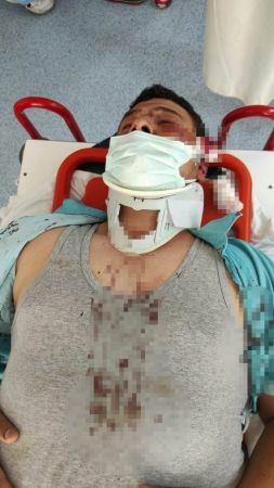 Türkkan’ın adamlarının darp ettiği muhabirin yüzündeki iz bir ömür kalacak